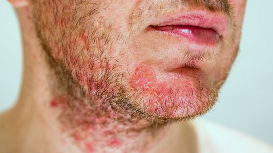 Can Red Light Help Treat Eczema?