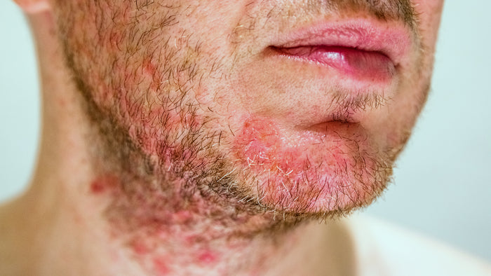 Red Light Therapy for Eczema: Does It Actually Help?