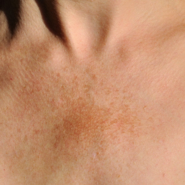 Red Light Therapy and Melasma: Read This Before You Start